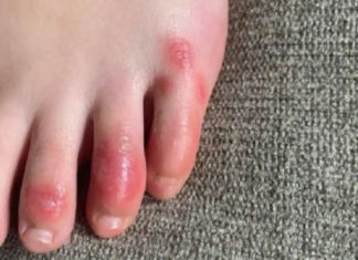 Know-more-about-Covid-toe